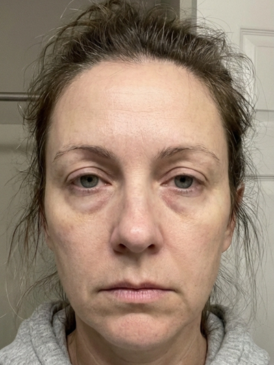 Before - Katy N.